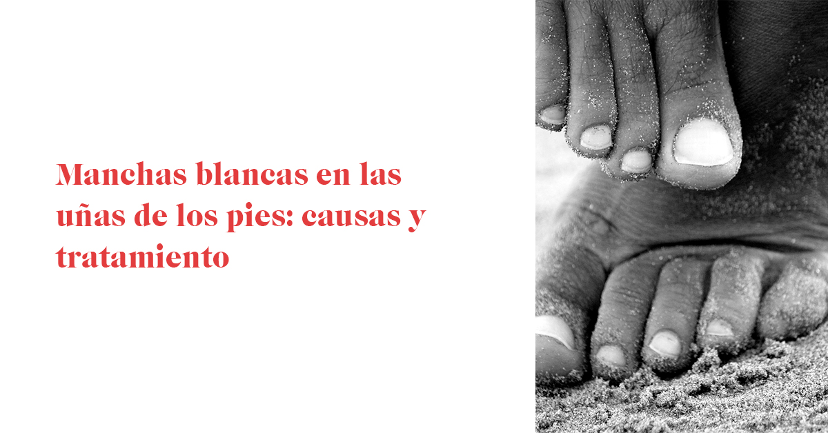 Manchas blancas en las uñas de los pies: causas y tratamiento